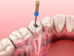 endodontia